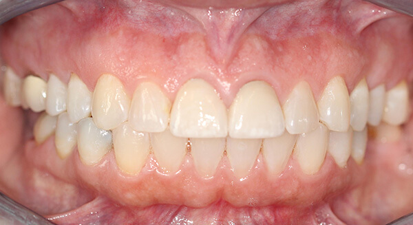 Cosmetic Dentistry After Photo