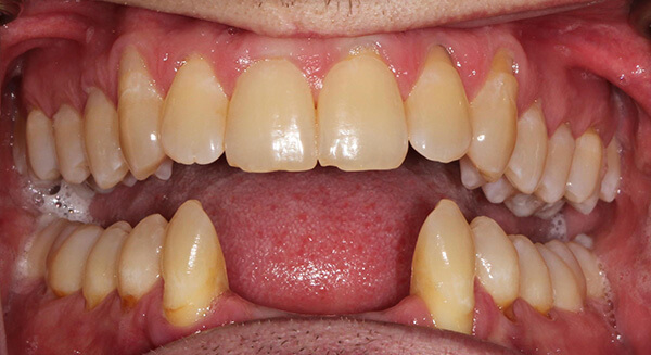 Cosmetic Dentistry Before Photo