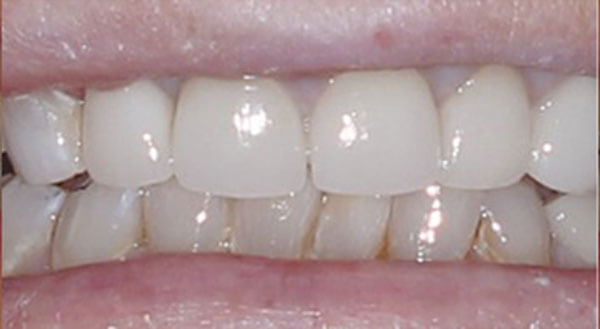 Cosmetic Dentistry After Photo - Face