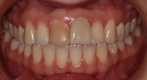 Cosmetic Dentistry Before Photo